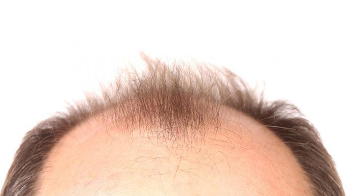 Mezoterapia skóry głowy – wskazania i przeciwwskazania do zabiegu